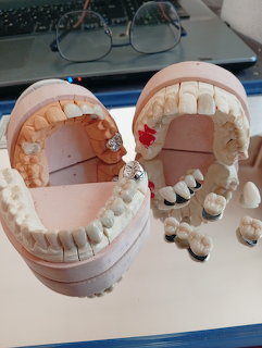 Two dental jaw models with teeth and individual dental crowns on a desk near a laptop