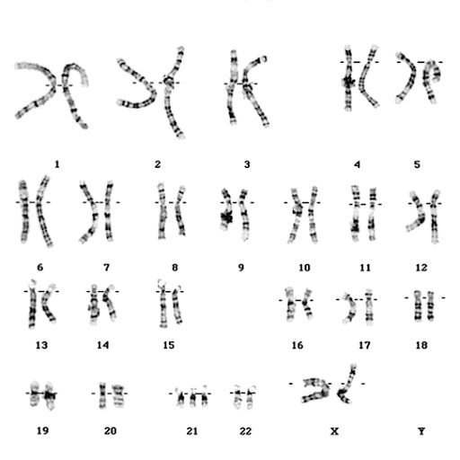 Human Chromosome Karyotype