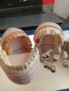 Dental plaster jaw models with prosthetic teeth and crowns on a desk in front of a laptop